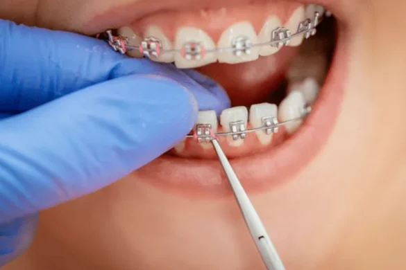 Braces for Kids & Adults