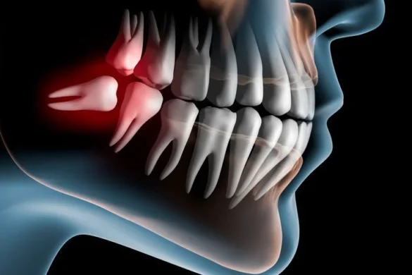 Wisdom Tooth Surgery