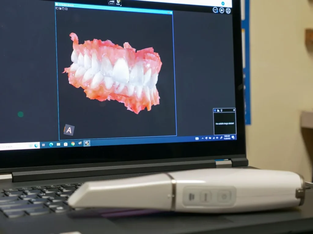 Digital Impressions & Intraoral Scanning