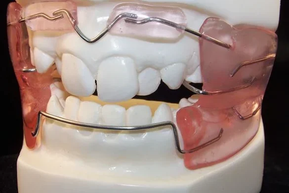 Orthodontics Appliances (For Growth Modification)