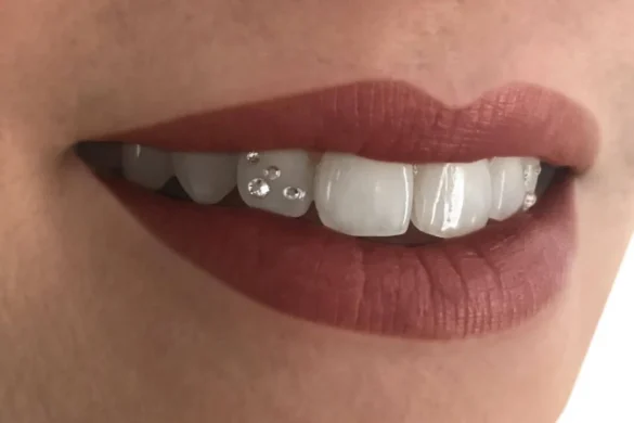 Dental Jewelry