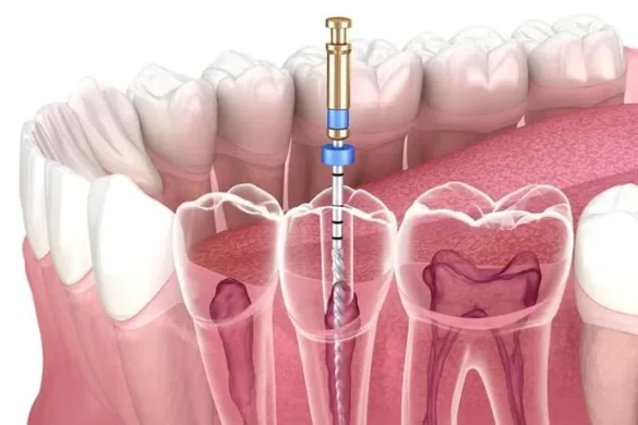 Root Canal Treatment