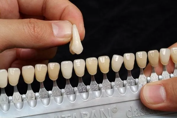 Tooth-Colored Fillings